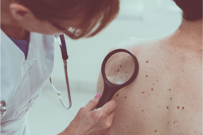 Câncer de pele: Todos os sinais que deve ficar atento.